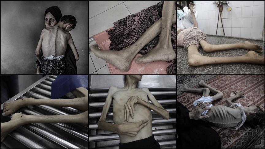 الصحة بغزة: تسجيل 7 حالات وفاة بسبب المجاعة خلال الـ24 ساعة الماضية