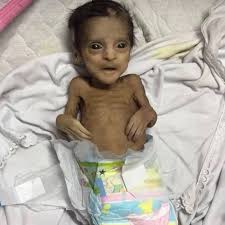 استشهاد طفل في قطاع غزة نتيجة المجاعة وسوء التغذية