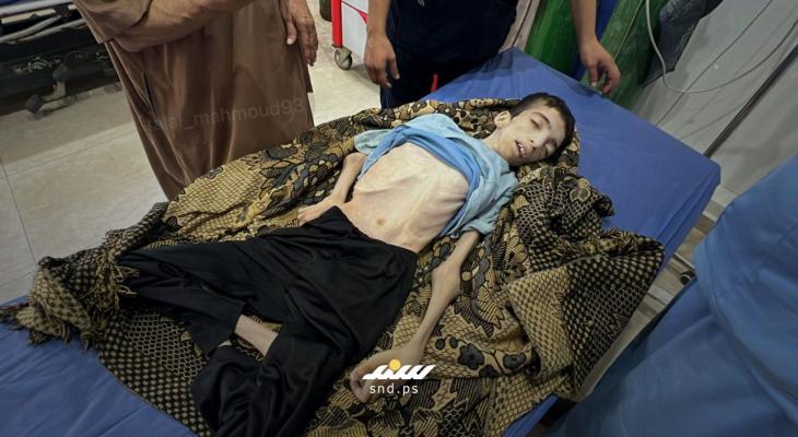 استشهاد شاب فلسطيني ثان اليوم بسبب سوء التغذية والتجويع بغزة