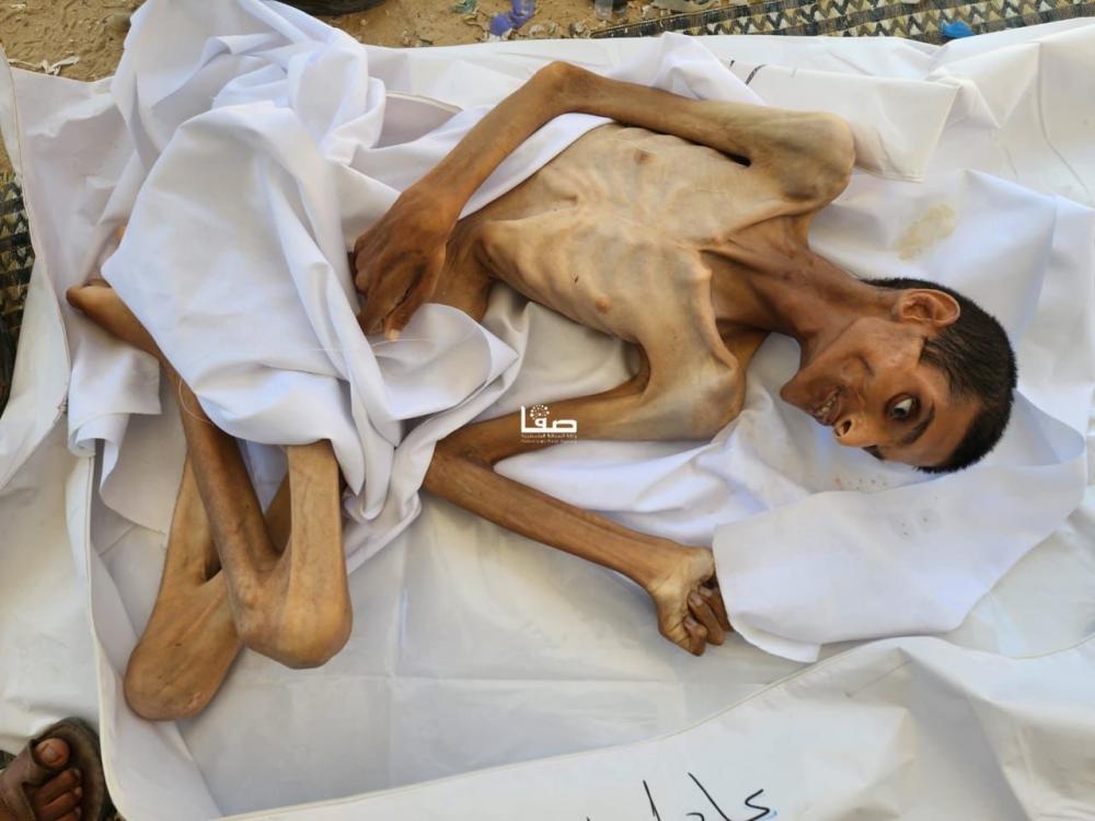 الإغاثة الطبية بغزة: يتوفى المجوعون لعدم وجود إمكانات لانقاذهم