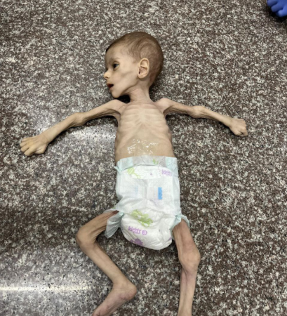 الصحة بغزة: تسجيل 14 حالات وفاة خلال الـ24 ساعة الماضية نتيجة المجاعة