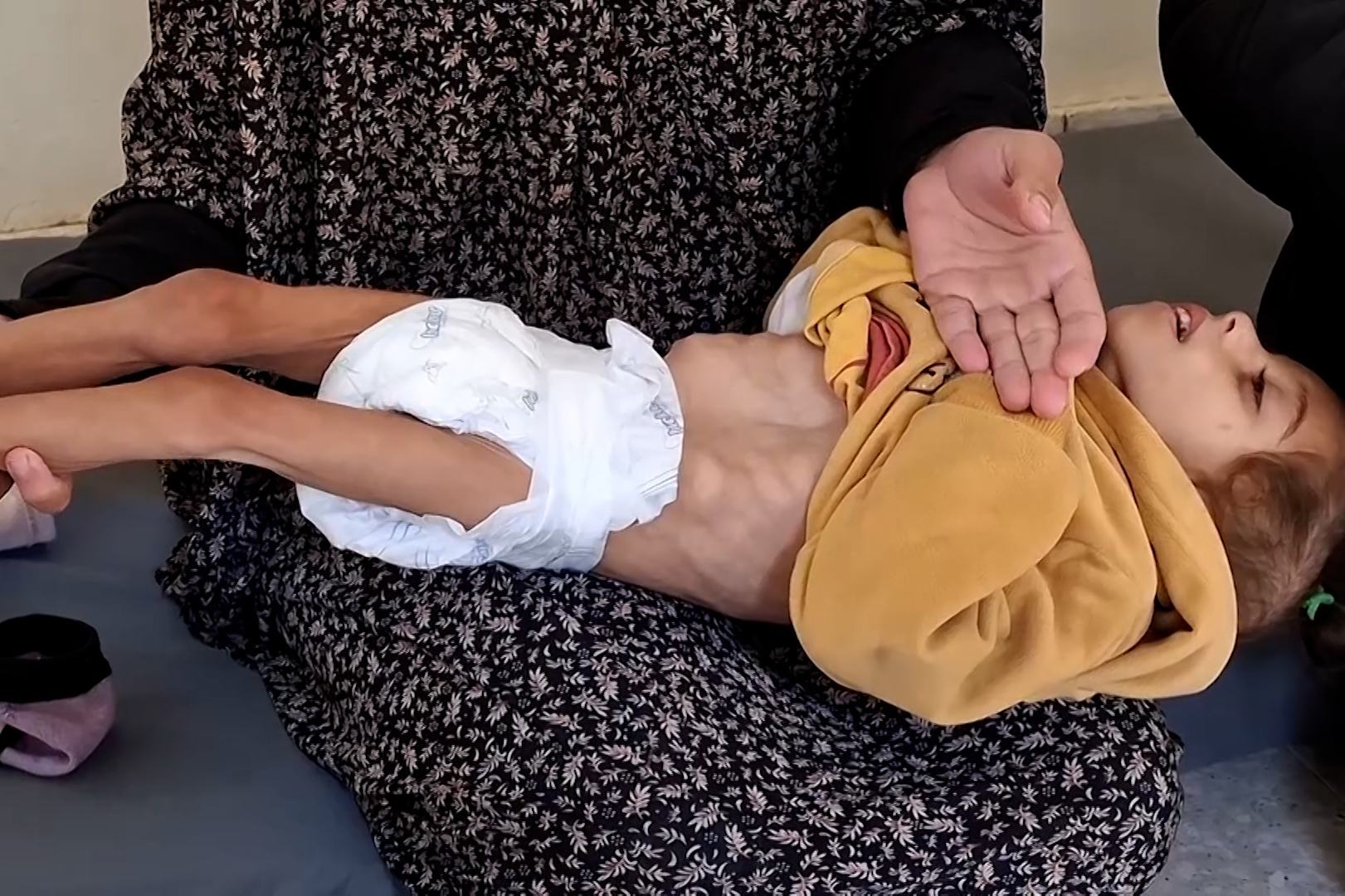 "أونروا”: طفل من كل 10 أطفال يخضعون للفحص بغزة يعاني من سوء التغذية