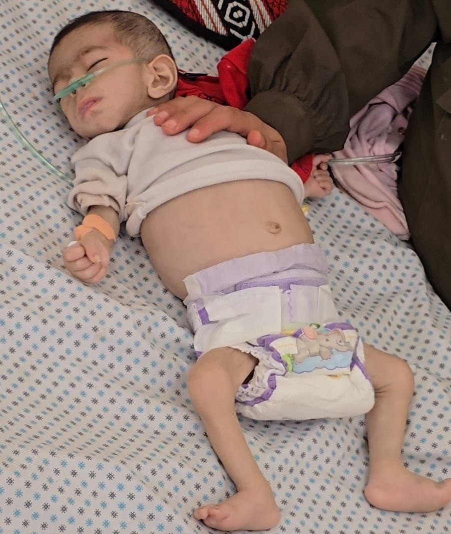 استشهاد طفلة فلسطينية بسبب المجاعة الناجمة عن حصار العدو الإسرائيلي على غزة