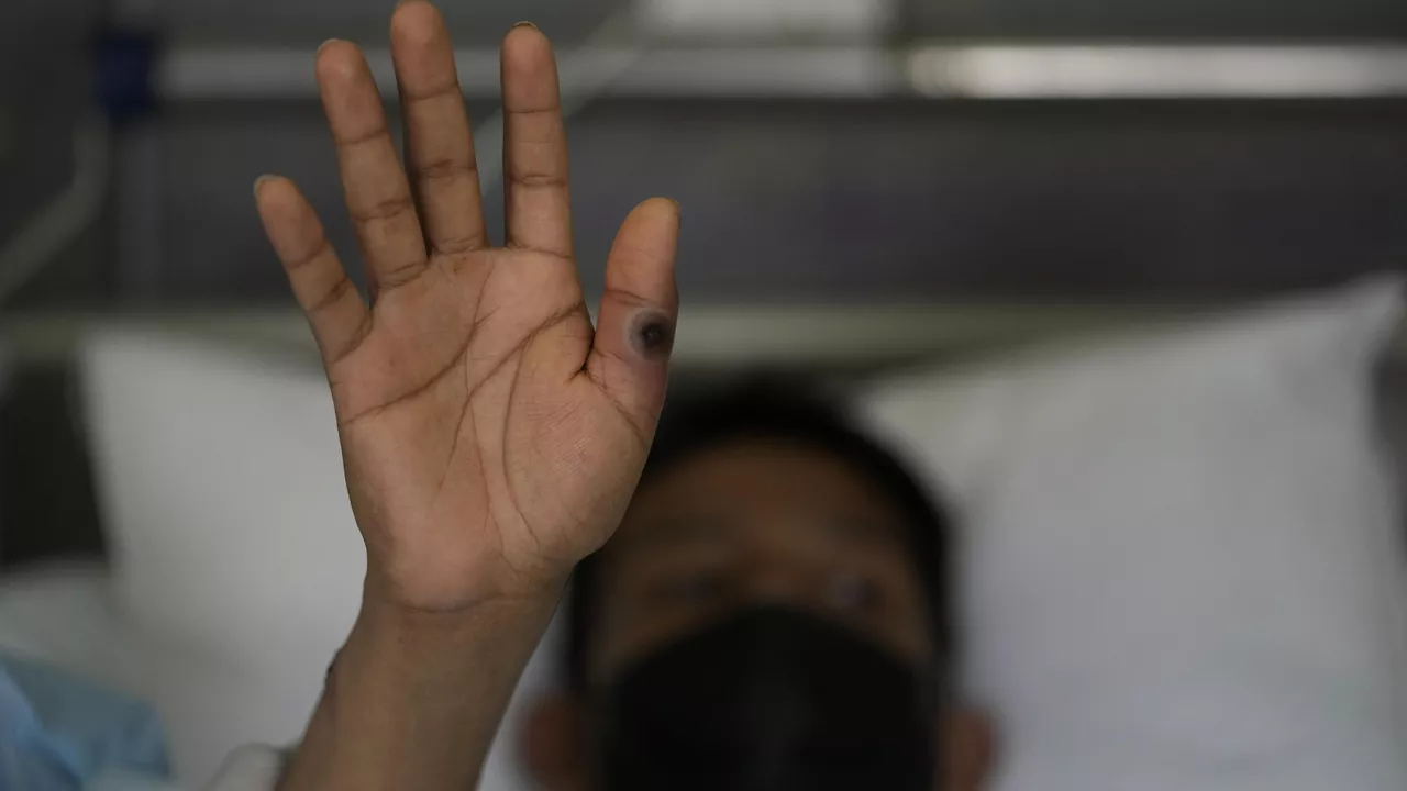 فاينينشال تايمز:12 دولة أفريقية تجد صعوبة في مكافحة تفشي جدري القرود