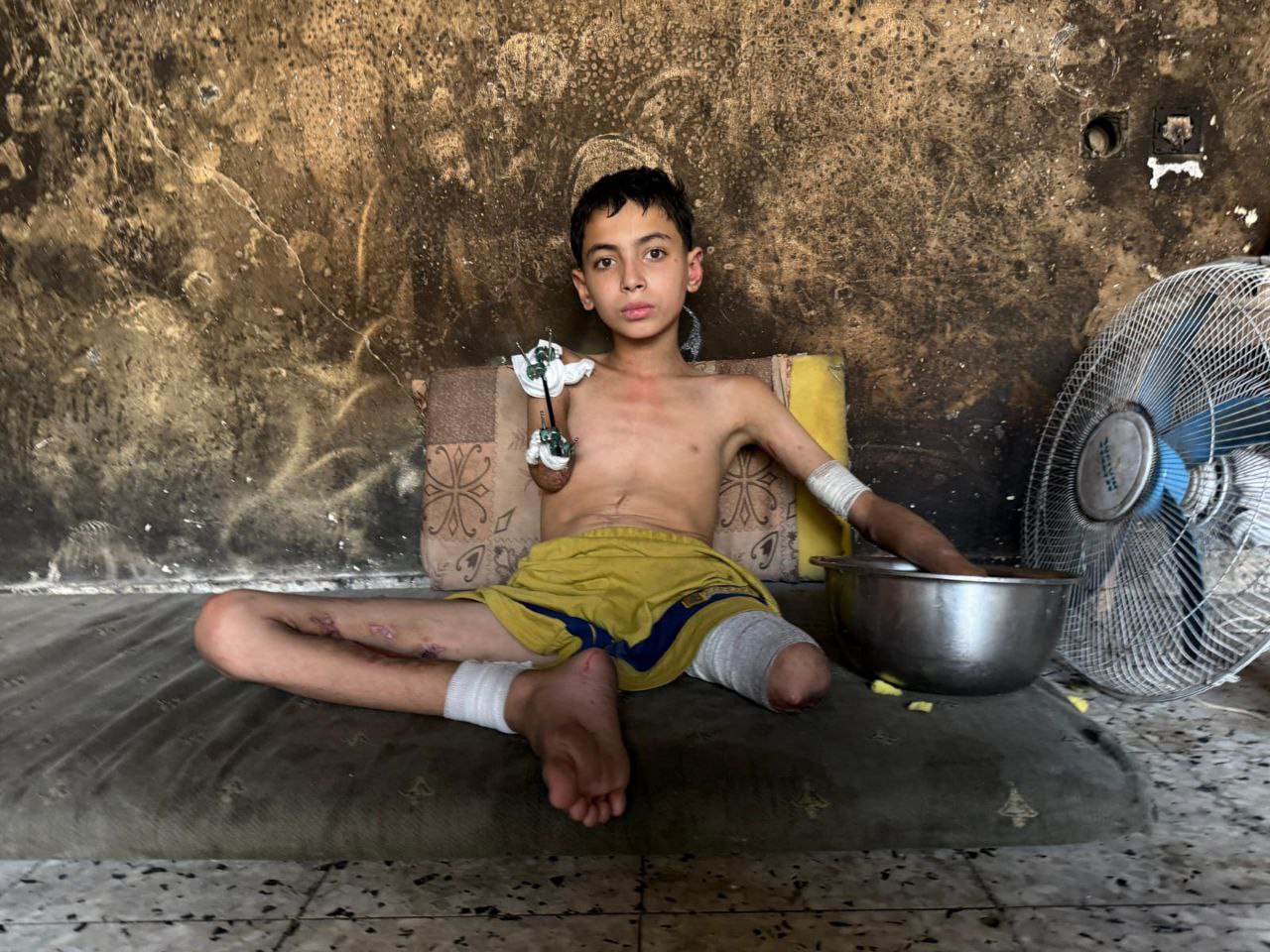 سمير زقوت.. طفلٌ غزّاوي قَطعت مُسيَّرة صهيونية أحلامه وأطرافه