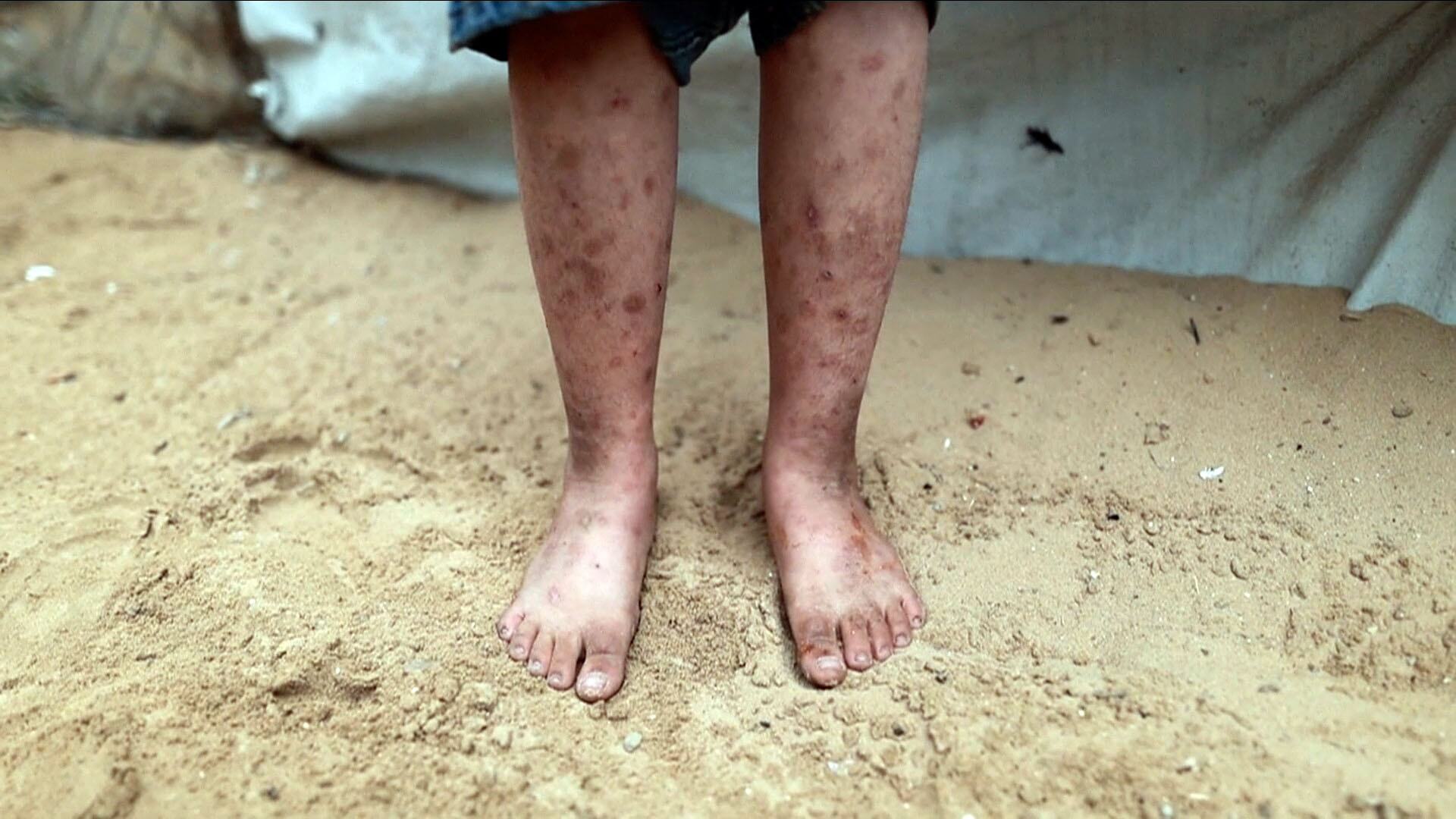 الصحة العالمية: 17 ألف حالة إصابة مرتبطة بالقوارض في غزة ونقص الأدوات الصحية يفاقم التحديات