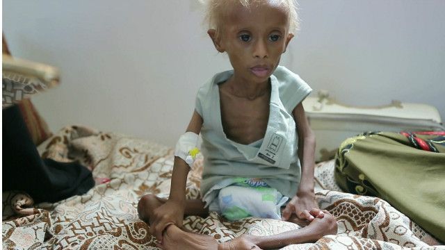 الحرب في اليمن.. السبب في وقوع البلد في شرك أسوأ أزمة إنسانية في العالم الحرب في اليمن.. السبب في وقوع البلد في شرك أسوأ أزمة إنسانية في العالم