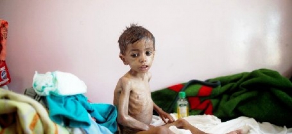 مدير الصحة بالجوف يدعو المنظمات الدولية إلى دعم القطاع الصحي لخفض حالات سوء التغذية مدير الصحة بالجوف يدعو المنظمات الدولية إلى دعم القطاع الصحي لخفض حالات سوء التغذية