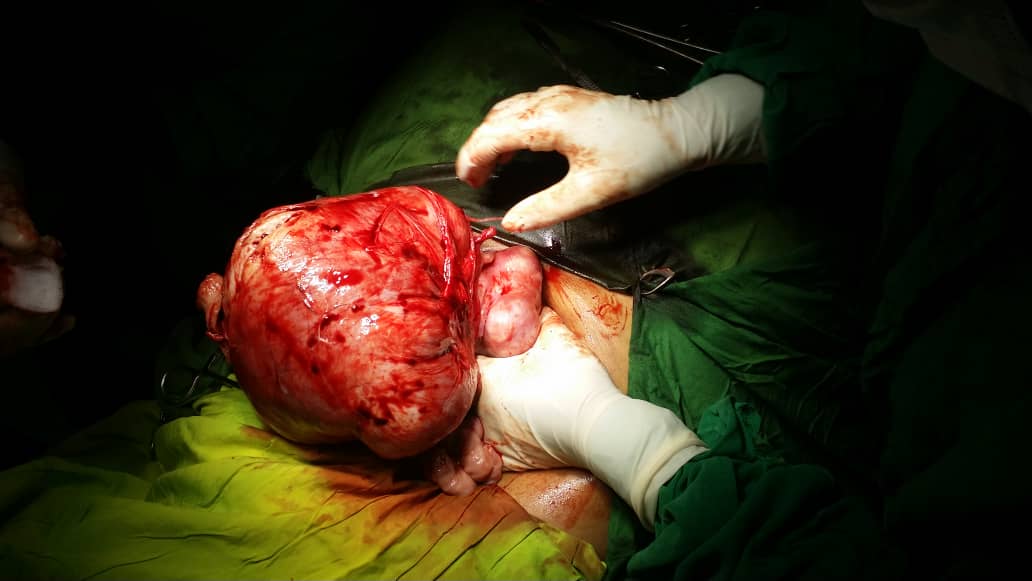 بعملية ناجحة .. استئصال ورم من رحم امرأة في مستشفى صعفان بمحافظة صنعاء بعملية ناجحة .. استئصال ورم من رحم امرأة في مستشفى صعفان بمحافظة صنعاء