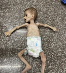 استشهاد طفلين شمال وجنوب قطاع غزة بسبب سوء التغذية والمجاعة