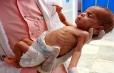 الصحة بغزة: 60 ألف طفل يتهددهم مضاعفات صحية خطيرة نتيجة سوء التغذية