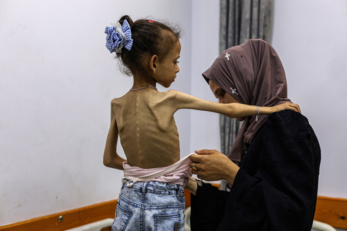 الأمم المتحدة تدعو لتحرك عاجل بعد وفاة أكثر من 100 طفل جوعاً في غزة