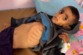 مدير مستشفى التحرير بغزة: تزايد حالات سوء التغذية وتفشي الشلل المتصاعد بسبب تلوث المياه