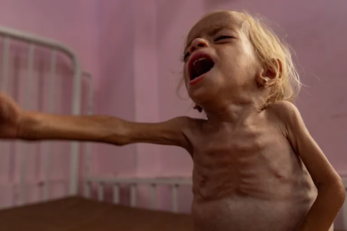 مسؤول طبي في غزة: عيادات سوء التغذية الخاصة بالأطفال مكتظة