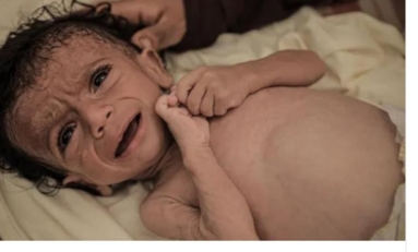غزة: انتشار "الكرش" بين الأطفال رغم المجاعة يشير إلى مرض كواشيوركور