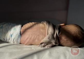 وفاة طفل بغزة بسبب سوء التغذية الحاد