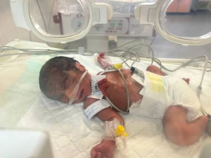 "البرش": نقص الأدوية الحاد أدى لزيادة واضحة في حالات التشوهات الخلقية بين المواليد الجدد في غزة