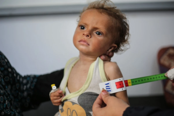 رئيس قسم الأطفال بمستشفى الرنتيسي: لا وسائل لمواجهة الأوبئة وانتشارها