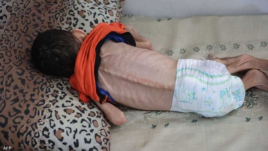 الصحة بغزة: سبع حالات وفاة جديدة بينهم طفلان نتيجة سوء التغذية في القطاع