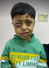 طفل غزاوي يصرخ مستغيثا من ورم خبيث ينهش عينه.."بدي أعيش زيُّ باقي الأطفال"