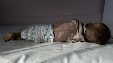 الصحة بغزة :تسجيل حالتي وفاة لطفلين نتيجة المجاعة خلال الـ24 ساعة الماضية