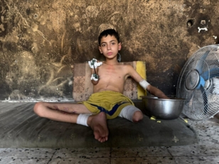 سمير زقوت.. طفلٌ غزّاوي قَطعت مُسيَّرة صهيونية أحلامه وأطرافه