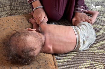 الصحة بغزة : تسجيل تسع حالات وفاة نتيجة المجاعة خلال الـ24 ساعة الماضية