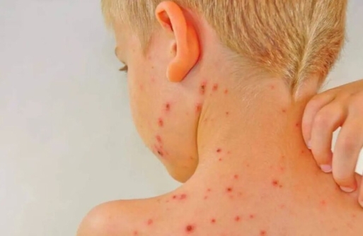 نائب ديمقراطي يدعو إلى إعلان حالة طوارئ صحية في اميركا بسبب الحصبة