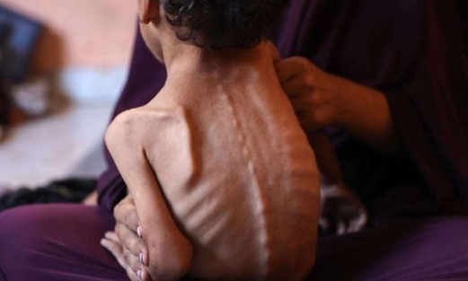 صحة غزة تسجل حالتي وفاة بالمجاعة وسوء التغذية خلال الـ 24 ساعة الماضية
