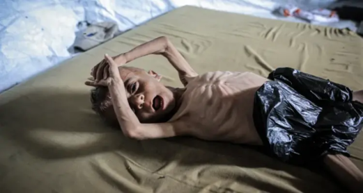 أرقام مفزعة حول الجوع في غزة