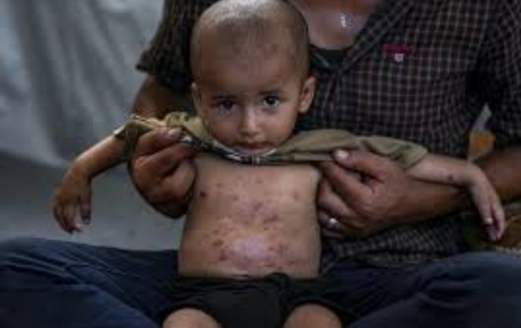 مدير مستشفيات غزة: نصف الحالات اليومية مصابون بالتهابات جلدية خطيرة تهدد حياتهم