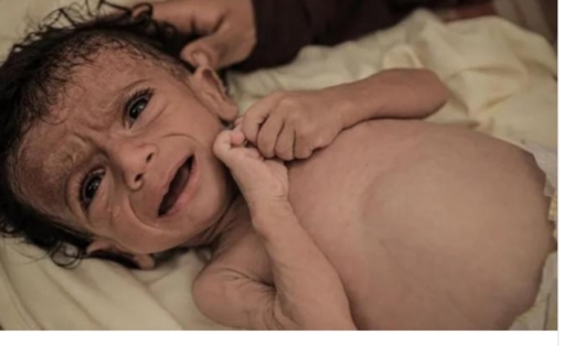 غزة: انتشار "الكرش" بين الأطفال رغم المجاعة يشير إلى مرض كواشيوركور