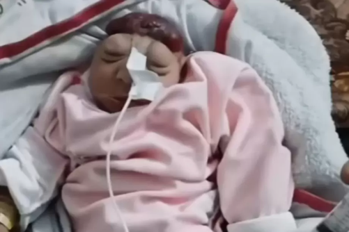 ارتفاع ملحوظ في تشوهات الأجنة بين النساء الحوامل بقطاع غزة