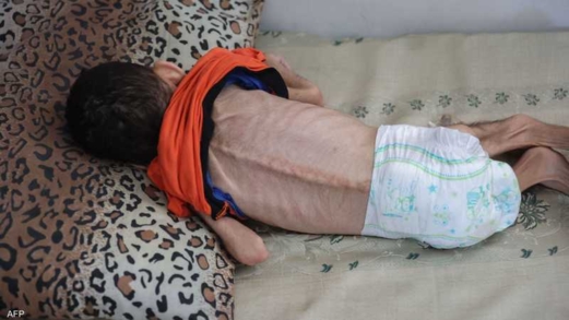 الصحة بغزة: سبع حالات وفاة جديدة بينهم طفلان نتيجة سوء التغذية في القطاع