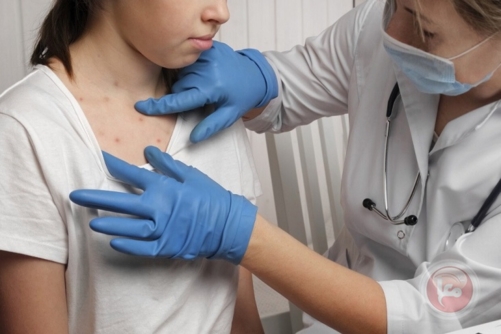 الحصبة تعود بقوة إلى أمريكا بأكثر من ألف إصابة مؤكدة و3 وفيات