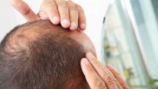 علماء يتوصلون إلى بروتين لعلاج تساقط الشعر