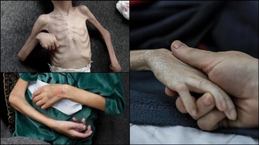 مديرالإغاثة الطبية بغزة: 17 ألف طفل فلسطيني يعانون من سوء تغذية حاد