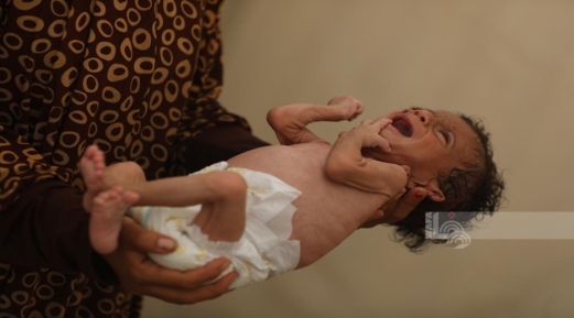  الصحة بغزة :تسجيل سبع وفيات نتيجة المجاعة خلال الـ24 ساعة الماضية