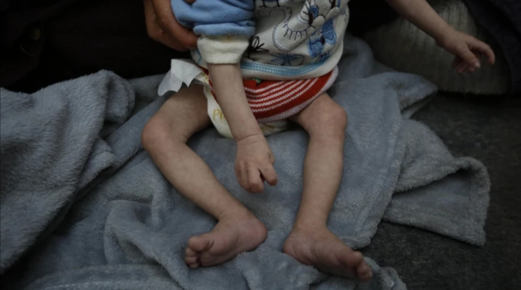 الصحة بغزة: تسجيل حالة وفاة نتيجة المجاعة خلال الـ24 ساعة الماضية