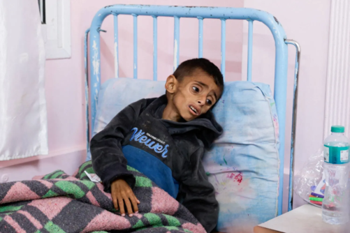 اليونيسف تحذر من تسارع خطير في سوء التغذية الحاد بين أطفال غزة