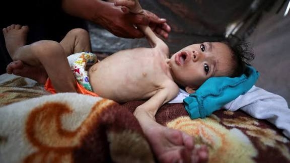 "الأونروا": 508 أطفال في قطاع غزة مصابون بسوء التغذية الحاد