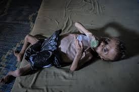 "يونيسف": 112 طفلًا يدخلون دائرة سوء التغذية يوميًا في قطاع غزة