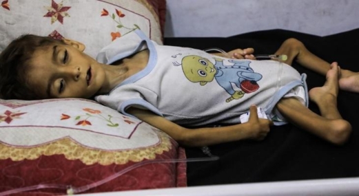 استشهاد شقيقين فلسطينيين بسوء التغذية في مدينة غزة