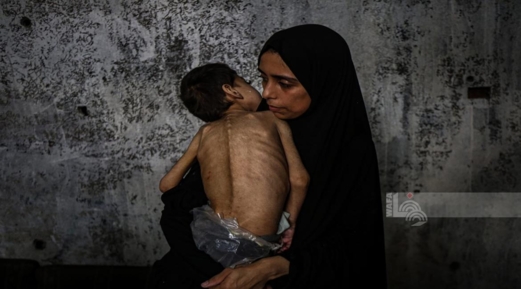 4 وفيات نتيجة المجاعة وسوء التغذية خلال الـ24 ساعة الماضية في قطاع غزة