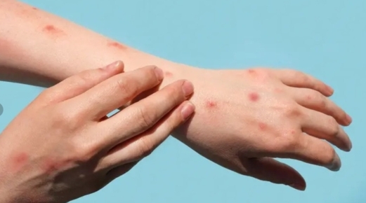 تسجيل أوّل إصابة محتملة بفيروس جدري القرود في تايلاند