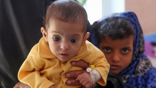 الحرب في اليمن قتلت 85 ألف طفل
