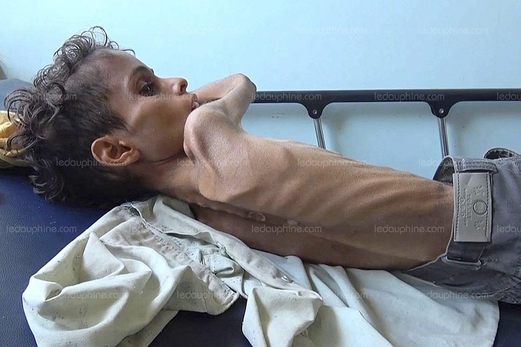 84 ألف طفل ضحايا الجوع في اليمن وبن زايد في ضيافة ماكرون