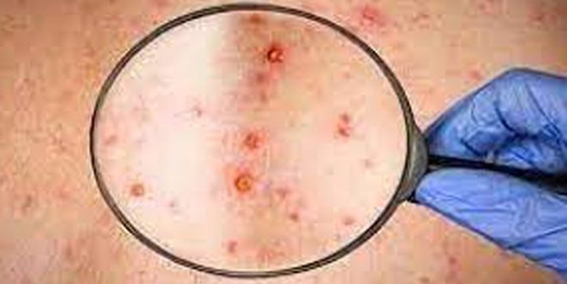 77 إصابة بـ (جدري القردة) في كندا