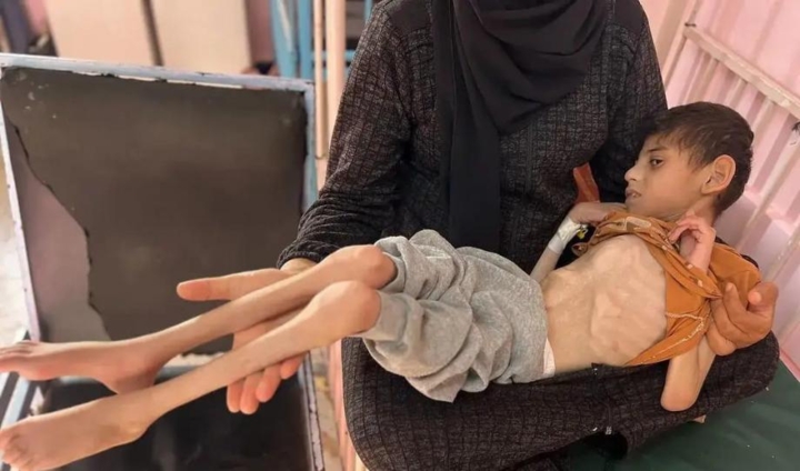 طفلٌ غزّي يصارع الجوع والمرض وفقدان البصر داخل خيمة نزوح