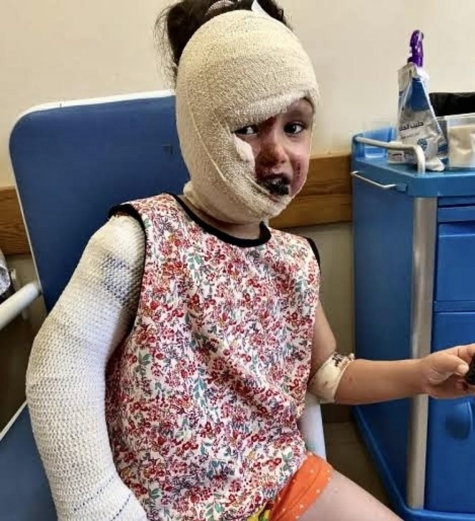 لهيب الصيف يكمل ما بدأته الحرب.. مصابو الحروق في غزة يواجهون عذابًا بلا علاج